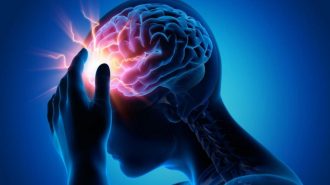 Inteligencia artificial ayuda a tratar a pacientes con accidente cerebrovascular isquémico